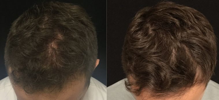 Before &After